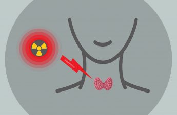 Radioactive iodine therapy