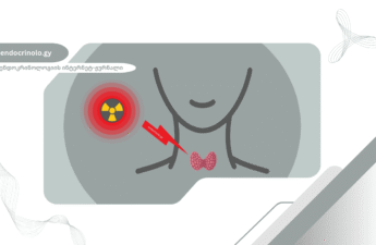 რადიოაქტიური იოდით თერაპია