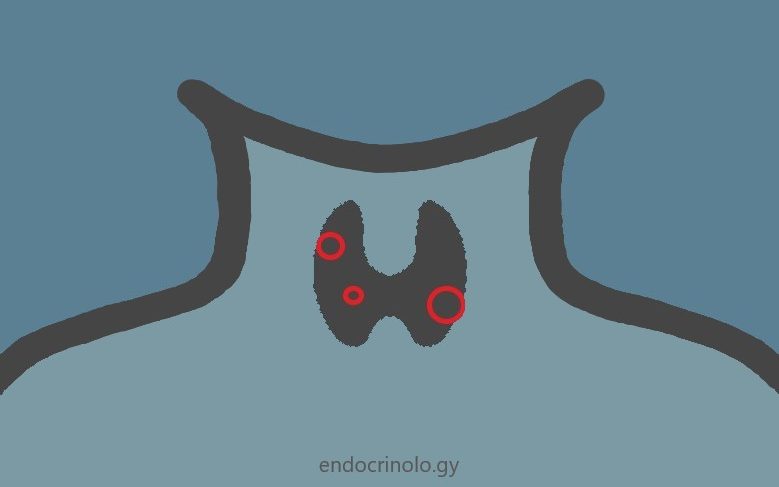 Thyroid nodules