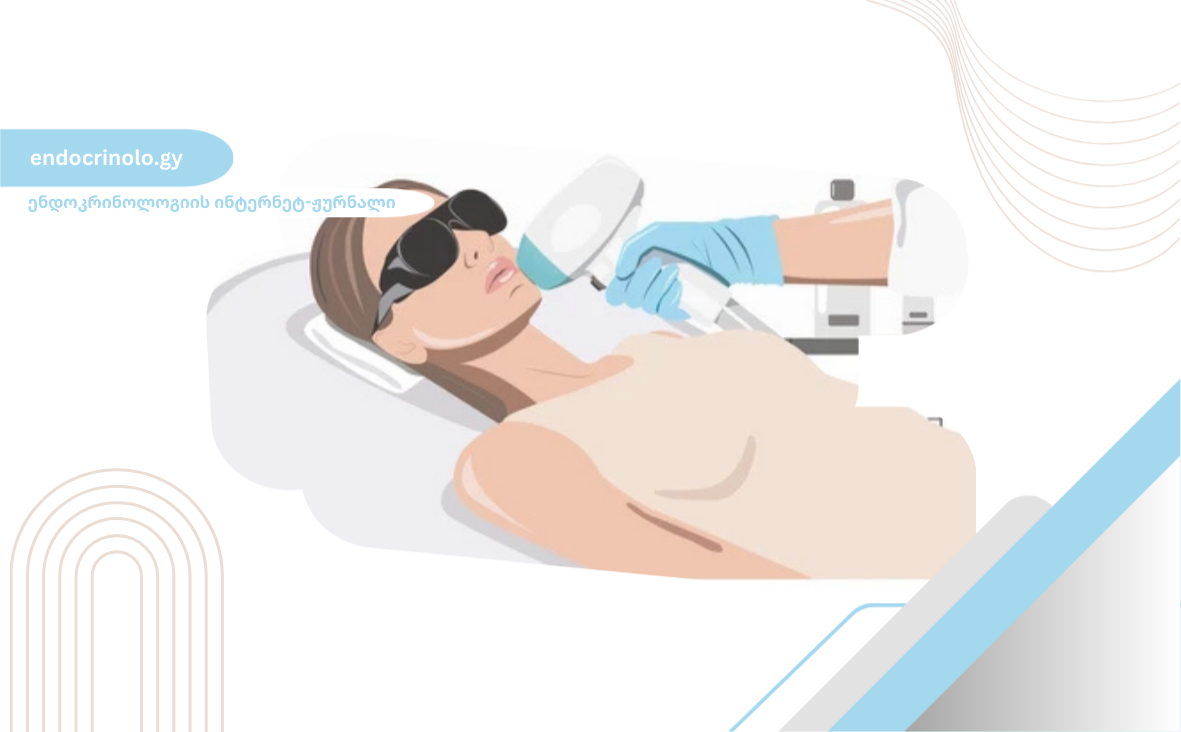 ლაზერული ეპილაცია